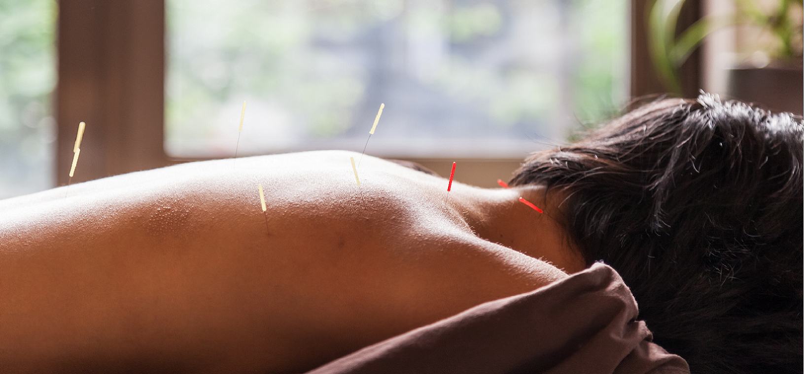 Acupuncture & Moxibustion